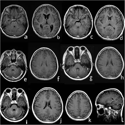 A Case Report of Autoimmune Glial Fibrillary Acidic Protein Astrocytopathy Diagnosed After Long Term Diagnosis of Chronic Lymphocytic Inflammation With Pontine Perivascular Enhancement Responsive to Steroids